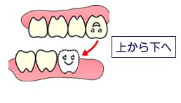 歯が連なって失われているとき