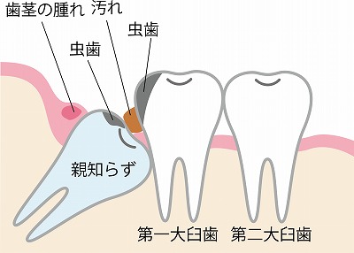 虫歯や歯周病の予防