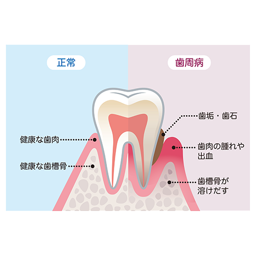 歯周病の原因