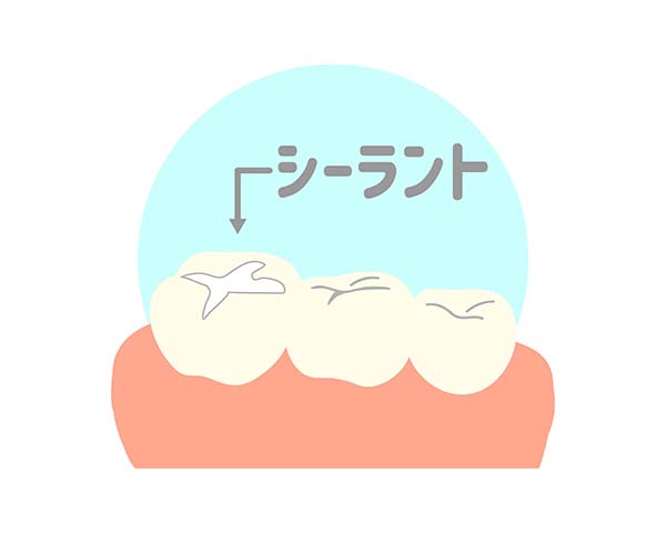 削らない 予防処置 ( シーラント )